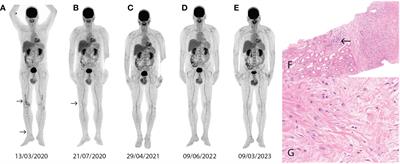 Case report: Targeted treatment strategies for Erdheim-Chester disease